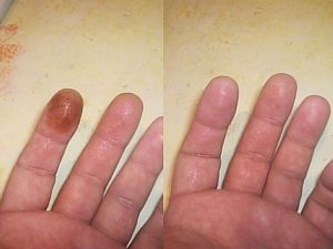 permanganat de potasiu din ciuperca unghiilor de pe mâini